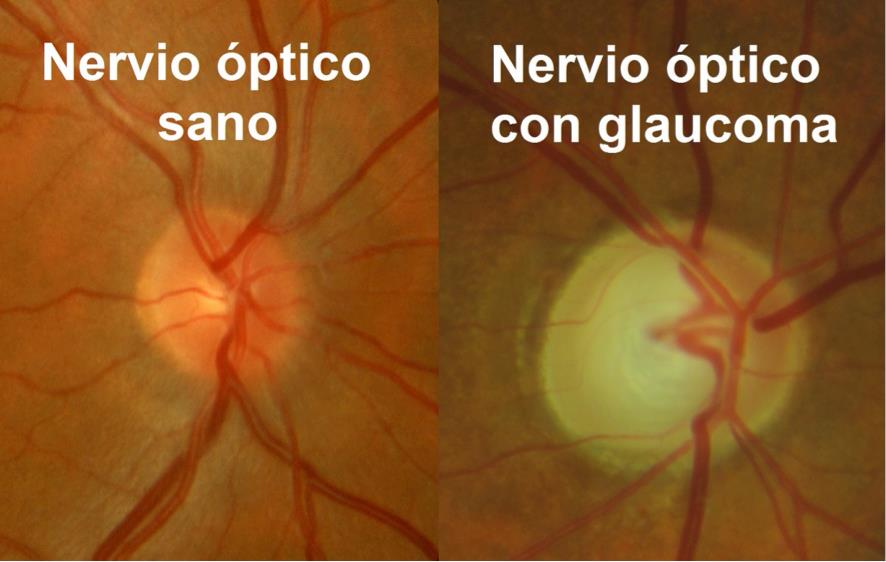 Nervio óptico sano y con glaucoma